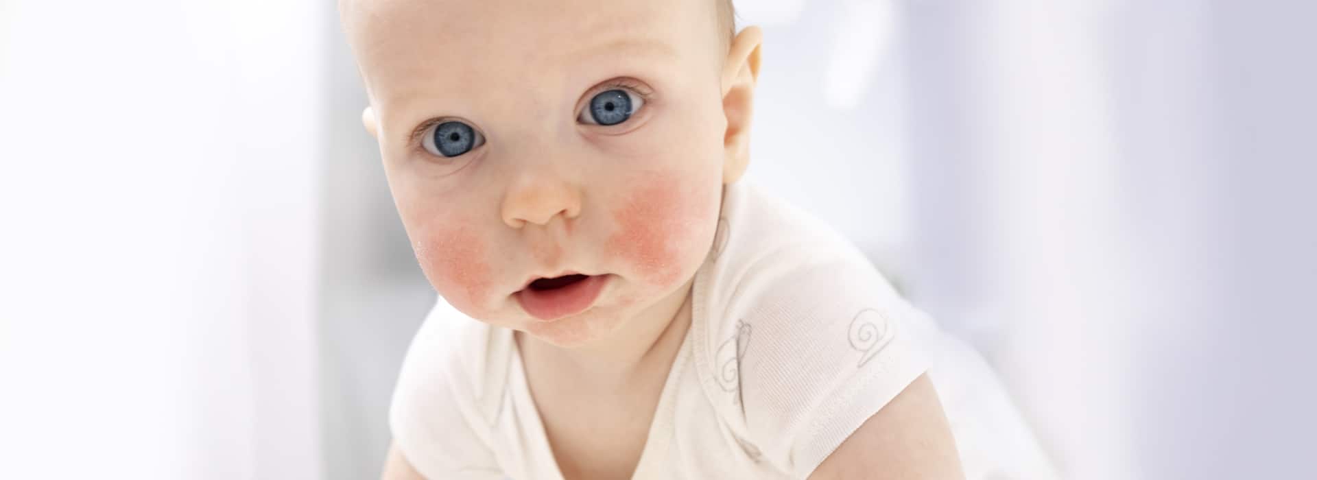 In Salute - Eczema neonato